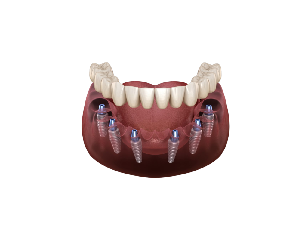 A 3D model showing a full arch of replacement teeth supported by six dental implants placed in the jaw.