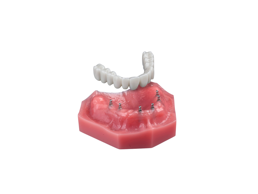 A dental model showing mini dental implants placed in the gums with a removable denture positioned above them.