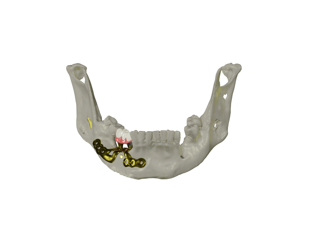 A jaw model showing a subperiosteal dental implant placed on top of the bone with metal framework and artificial teeth attached.