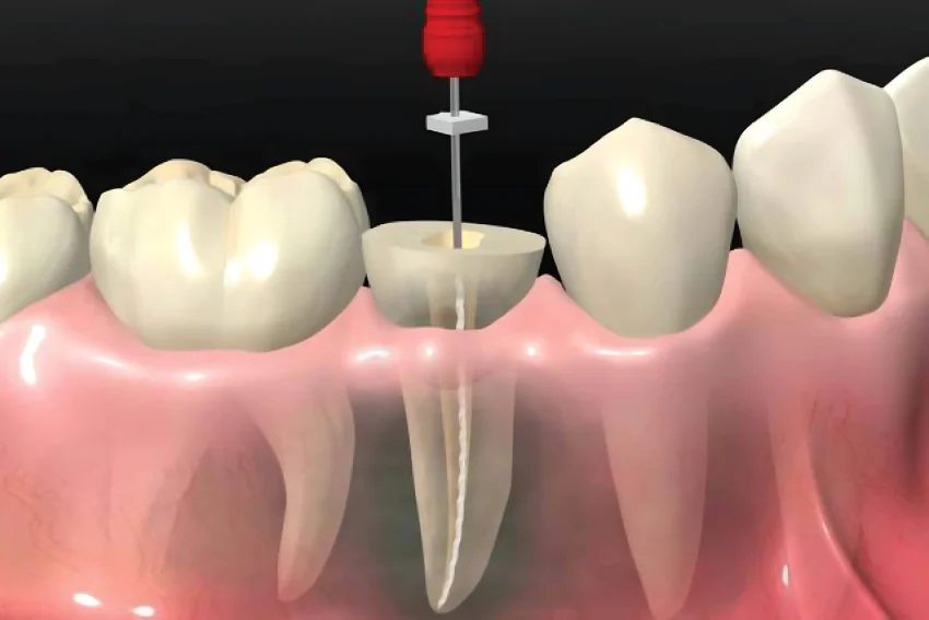 RCT Treatment In Chandigarh