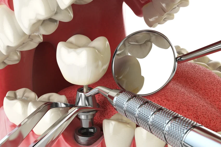 3D illustration showing a single tooth dental implant being placed with dental tools and mirror