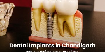 Dental Implants in Chandigarh: The Ultimate Guide
