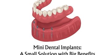 Illustration of mini dental implants used to stabilize dentures at Elite Dental and Implant Clinic in Chandigarh.