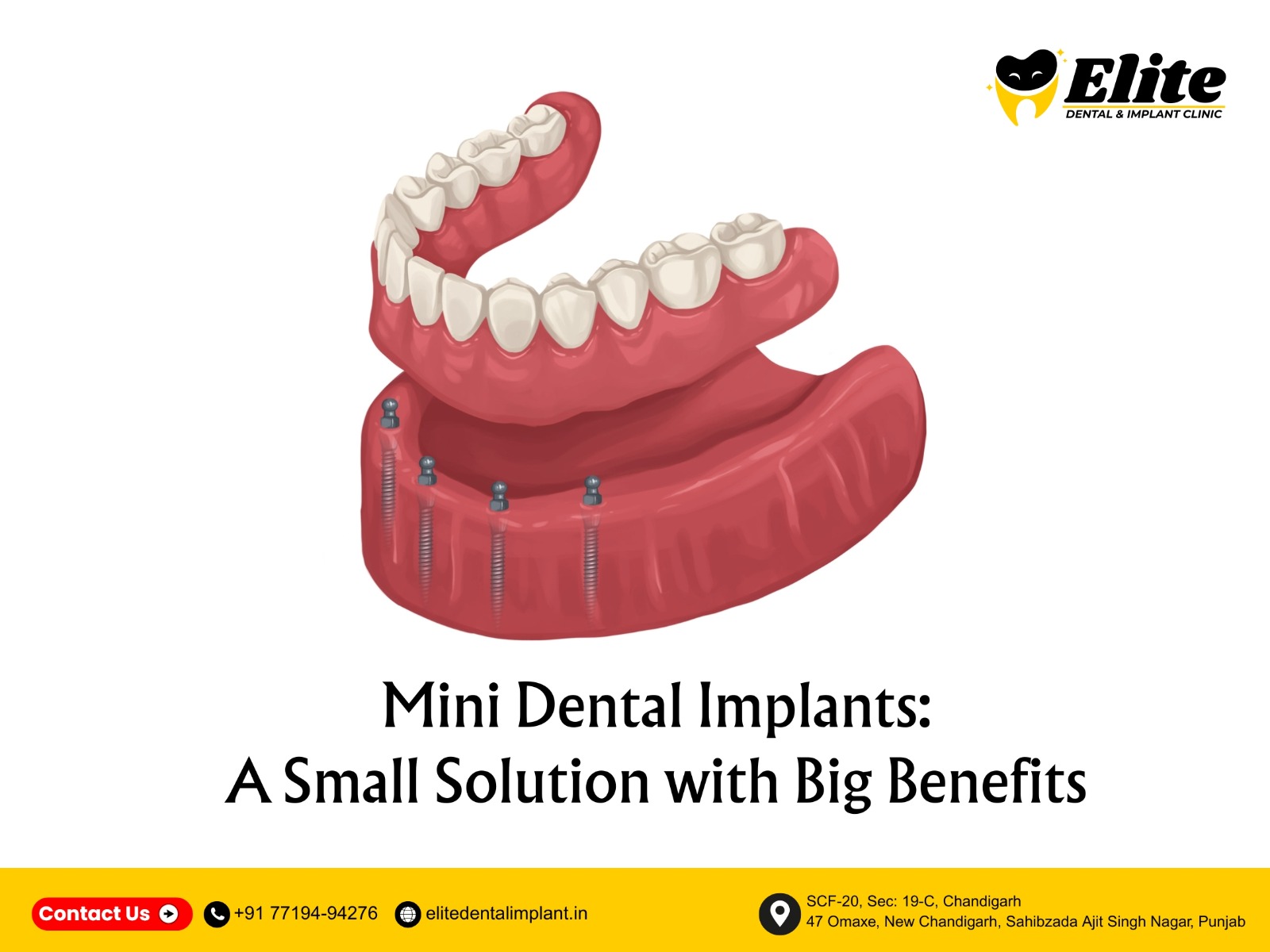 Illustration of mini dental implants used to stabilize dentures at Elite Dental and Implant Clinic in Chandigarh.