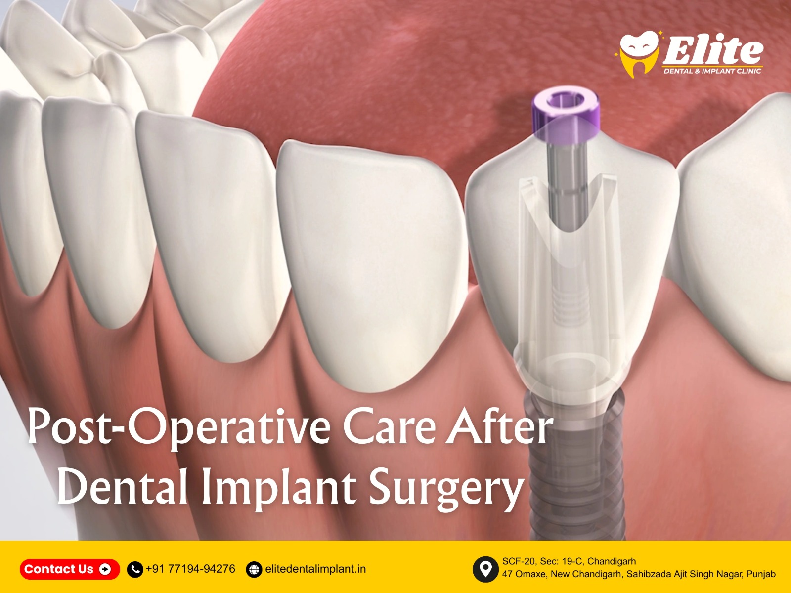 Illustration of dental implant healing process showing implant placement and gum recovery at Elite Dental & Implant Clinic, Chandigarh