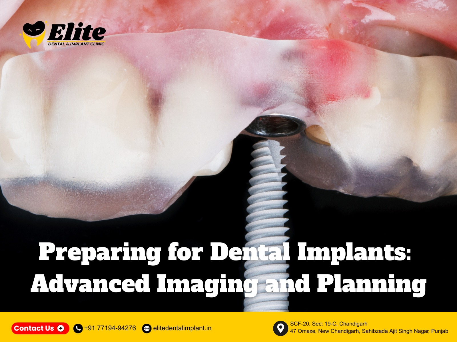 Close-up of dental implant surgical guide used for precise implant placement during advanced imaging and planning at Elite Dental & Implant Clinic.