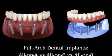 Comparison of All-on-4, All-on-6, and All-on-8 full-arch dental implant systems showing implant placement variations.