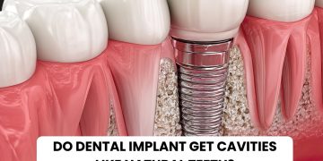 Do dental implant get cavities like natural teeth?