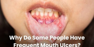 Why Do Some People Have Frequent Mouth Ulcers?