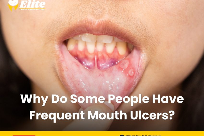 Why Do Some People Have Frequent Mouth Ulcers?