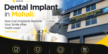 Dental Implant in Mohali: How Can Implants Restore Your Smile After Tooth Loss?